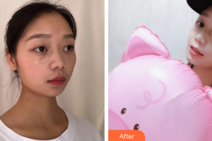 廣州康華清醫(yī)學(xué)美容門診部潘立清整形價格表附水氧活膚案例展示