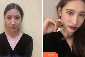 廣州愈生醫(yī)院美容整形中心李寅整形價格表附肋軟骨隆鼻案例展示