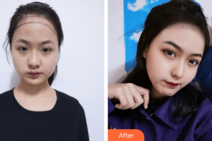 廣州韓妃醫(yī)學(xué)美容醫(yī)院萬麗整形價格表附發(fā)際線種植案例展示