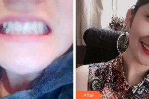 上海百達(dá)麗醫(yī)療美容醫(yī)院李琪整形價格表附牙齒正畸案例展示