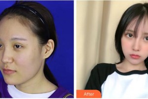 上海東方麗人美容醫(yī)療醫(yī)院吳永波整形價格表附鼻部手術(shù) 面部吸脂案例展示