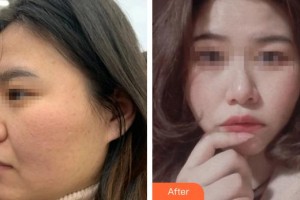 民航上海醫(yī)院整形外科段曉光整形價格表附下頜角磨骨案例展示