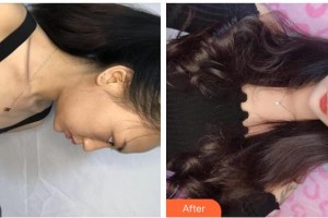 上海伊美爾港華醫(yī)療美容醫(yī)院陳媛整形價格表附果酸煥膚案例展示