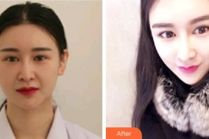 上海米瑞可醫(yī)療美容門診部李喆遠(yuǎn)整形價格表附面部輪廓案例展示