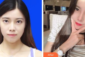 上海諾詩雅醫(yī)療美容醫(yī)院陳達(dá)整形價格表附肋軟骨隆鼻案例展示