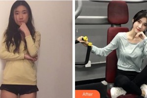 上海港華醫(yī)療美容醫(yī)院整形價格表附自體脂肪豐胸案例展示