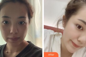 上海仁濟(jì)醫(yī)院整形外科顧偉整形價(jià)格表附頜面整形案例展示