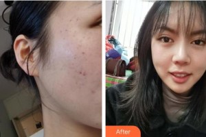 上海富華醫(yī)療美容醫(yī)院李梅整形價(jià)格表附面部祛斑案例展示