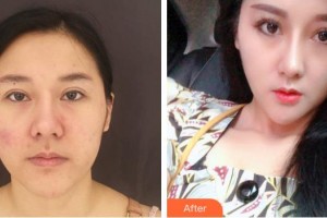 上海仁愛醫(yī)院整形美容科朱焱整形價(jià)格表附激光祛斑案例展示