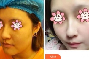 上海博愛醫(yī)院整形科傅文鳳整形價(jià)格表附激光祛斑案例展示