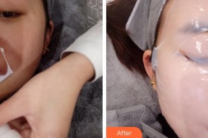 上海市皮膚病醫(yī)院醫(yī)療美容科石鈺整形價(jià)格表附光子嫩膚案例展示