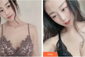 上海光博士醫(yī)療美容門診部阮雅君整形價(jià)格表附自體脂肪隆胸案例展示