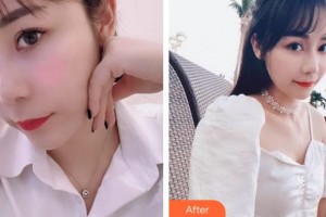 上海伊萊美醫(yī)療美容醫(yī)院劉海松整形價(jià)格表附合金烤瓷牙案例展示