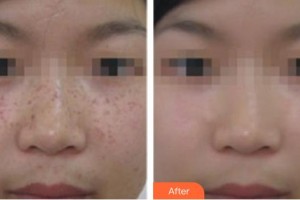 上海伊萊美醫(yī)療美容醫(yī)院莫雅晴整形價(jià)格表附祛斑案例展示