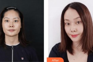 上?？祳W醫(yī)療美容醫(yī)院胡康容整形價格表附光子嫩膚案例展示