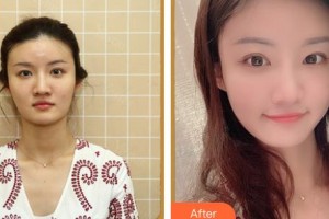 上海伊萊美醫(yī)療美容醫(yī)院何生靜整形價格表附曬后修復案例展示