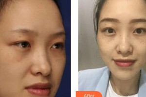 上海復麗醫(yī)療美容門診部林繡諭整形價格表附激光祛斑案例展示