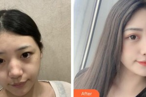 上海復旦大學附屬中山醫(yī)院整形外科施越冬整形價格表附激光祛斑案例展示