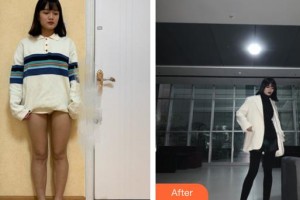 上海復麗醫(yī)療美容門診部張家偉整形價格表附吸脂瘦大腿案例展示