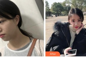上海復麗醫(yī)療美容門診部莊賀婷整形價格表附超激光美膚激光案例展示