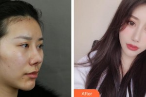 上?？叼愥t(yī)療美容門診部魏艷玲整形價格表附顴骨+夾脂墊案例展示