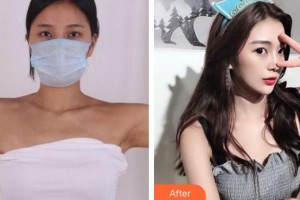 上海光博士醫(yī)療美容門診部李思住院醫(yī)師整形價格表附手臂吸脂案例展示