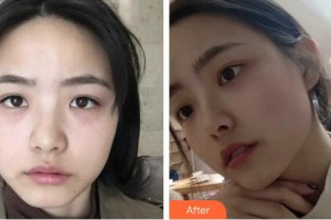 上海光博士醫(yī)療美容門診部張健整形價格表附超激光美膚祛雀斑曬斑案例展示