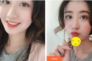 上海WA臻景醫(yī)療美容門診部馬克.伯曼整形價格表附面部填充案例展示