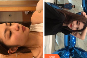 廣州市荔灣區(qū)人民醫(yī)院整形美容中心趙菲菲整形價格表附光子嫩膚案例展示