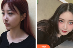 廣州番禺陽光整形美容醫(yī)院易東風(fēng)整形價格表附隆鼻案例展示