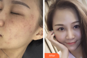 廣州曙光醫(yī)學(xué)美容醫(yī)院陳光平整形價格表附祛斑祛痣案例展示