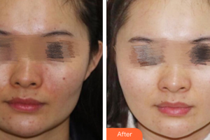 廣州解放軍第四五八醫(yī)院激光整形美容中心張陽整形價格表附美白亮膚祛痘印案例展示