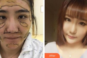 上海復麗醫(yī)療美容門診部鄭佳瑋整形價格表附自體脂肪案例展示