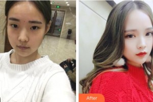 上海楊思醫(yī)院醫(yī)學美容科巴友良整形價格表附眼部手術案例展示