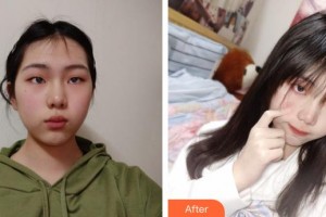 上海康爾麗醫(yī)療美容門診部鄭茂榮整形價格表附超激光美膚案例展示