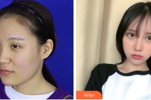 上海俏佳人整形外科門診部田苗苗整形價格表附鼻部手術 面部吸脂案例展示