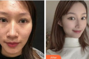 上海WA臻景醫(yī)療美容門診部GeorgiaLee整形價格表附微針祛痘案例展示