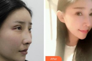 上海WA臻景醫(yī)療美容門診部KimSam整形價格表附雙眼皮修復案例展示