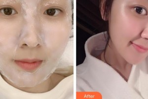 上海紐菲思醫(yī)療美容門診部孟玲玲整形價(jià)格表附點(diǎn)陣激光案例展示