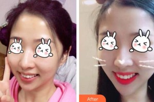 上海瑞東醫(yī)院美容皮膚科劉麗琳整形價格表附無針水光案例展示