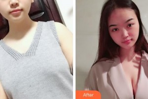 上海美立方整形醫(yī)院楊曉松整形價(jià)格表附濃縮豐胸真實(shí)案例展示