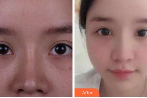 上海華美醫(yī)療美容醫(yī)院楊亞益整形價(jià)格表附眼部整形案例展示