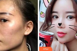 上海瑞東醫(yī)院美容皮膚科王泰然整形價格表附自體脂肪填充案例展示