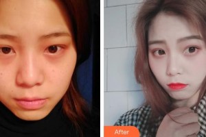 上海WA臻景醫(yī)療美容門診部李載成整形價(jià)格表附假體隆下頜案例展示