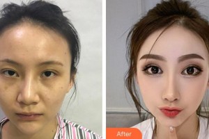 上海首爾麗格醫(yī)療美容醫(yī)院樸興植整形價(jià)格表附鼻部手術(shù)整形 眼瞼下至案例展示