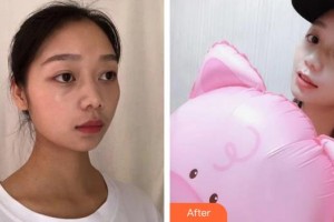 上海亞柏醫(yī)療美容診所曲妙軒整形價(jià)格表附全切雙眼皮+外眼角案例展示