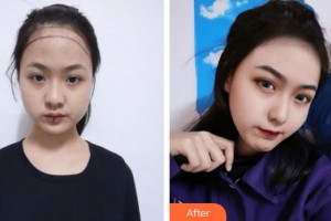 上海首爾麗格醫(yī)療美容醫(yī)院洪榕宅整形價(jià)格表附美女發(fā)際線種植案例展示