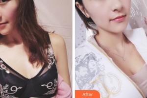 上海明慨醫(yī)療美容門診部慎全祥整形價(jià)格表附濃縮豐胸真實(shí)案例案例展示