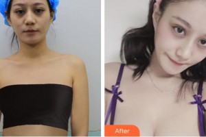 上海美侖醫(yī)療美容門診部姜哲諄整形價(jià)格表附假體隆胸棉花糖豐胸案例展示