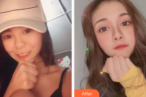 廣州解放軍第四五八醫(yī)院激光整形美容中心崔鳳祥整形價格表附玻尿酸導入案例展示